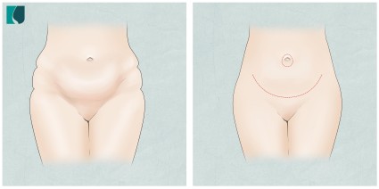 Abdominoplastia Clássica